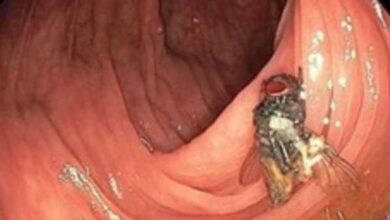 صورة “ذبابة حية في أمعاء رجل” تثير حيرة الأطباء