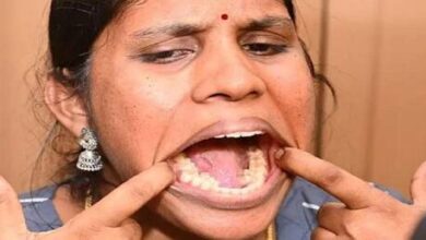 صورة شابة هندية تدخل موسوعة غينيس بعدد أسنانها